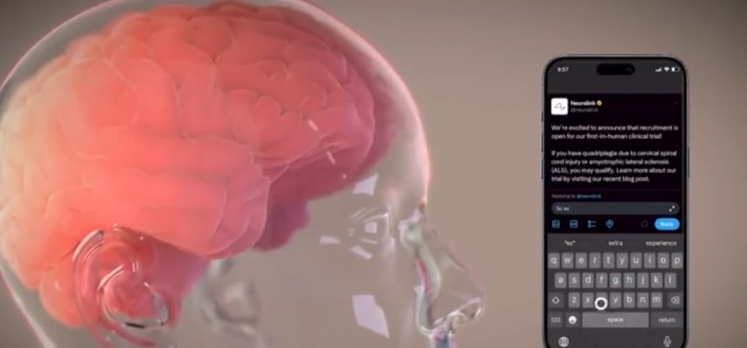 nxnoticias.com-el-chip-cerebral-de-elon-musk