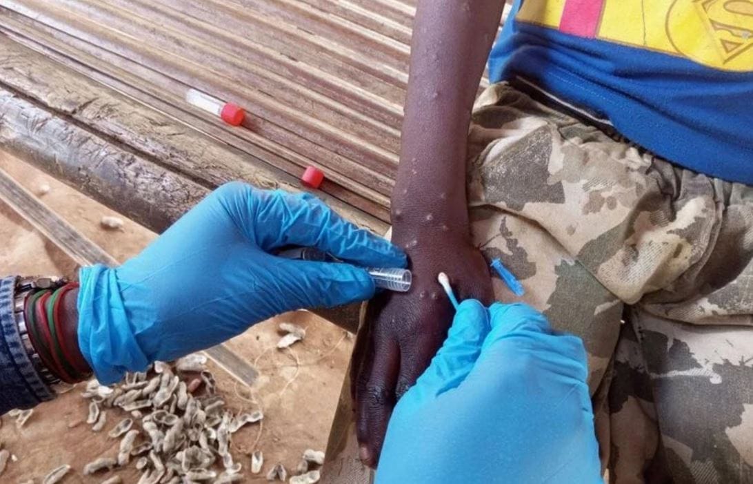 nxnoticias.com-oms-advierte-probabilidad-de-nuevos-brotes-de-mpox-en-europa