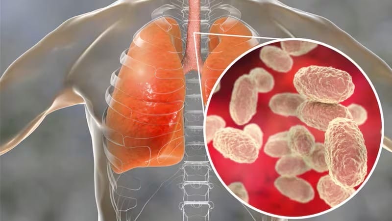 nxnoticias.com-aumentan-casos-de-tos-ferina-en-mexico-como-evitamos-contagios