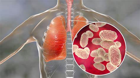 nxnoticias.com-brote-de-tos-ferina-en-mexico-como-podemos-evitar-contagios