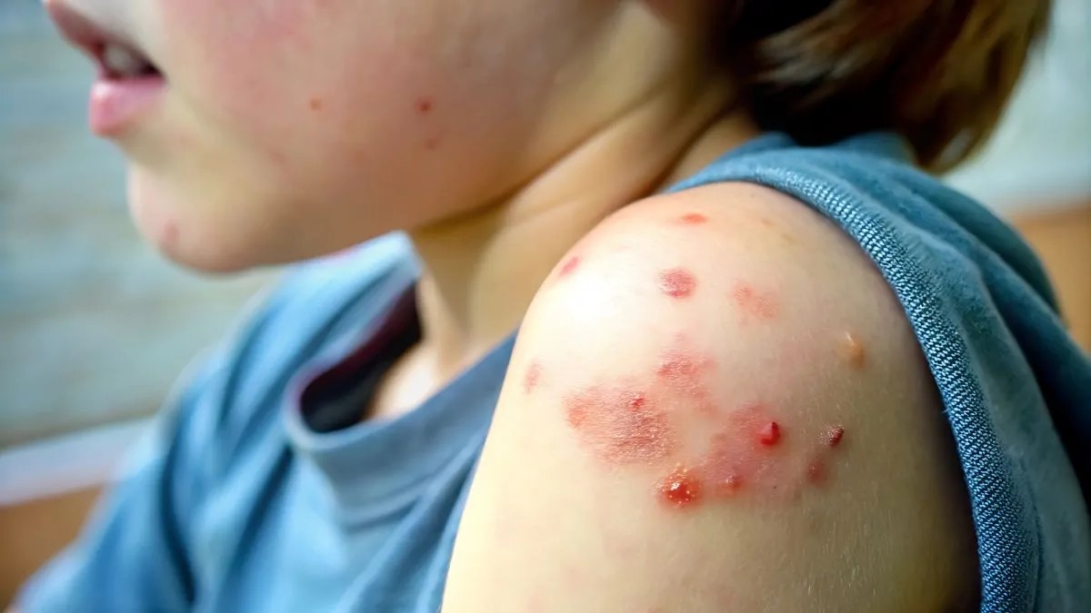 nxnoticias.com-brote-de-sarampion-se-dispara-en-chihuahua-mas-de-600-casos-y-en-aumento