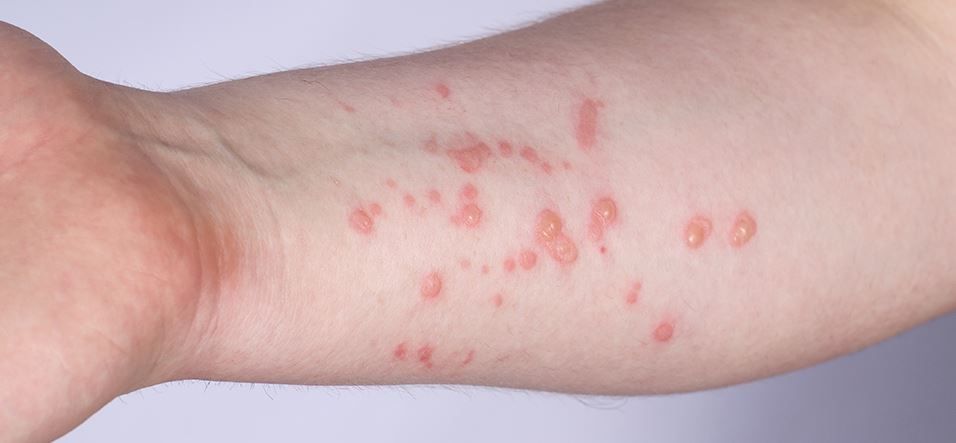 nxnoticias.com-aumentan-en-mexico-contagios-por-viruela-del-mono